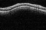 Moduł Jaskra: Skan siatkówki w odległości 3,4mm od tarczy nerwu wzrokowego.