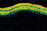 Moduł Jaskra: Skan siatkówki w odległości 3,4mm od tarczy nerwu wzrokowego wykonany w kolorze.